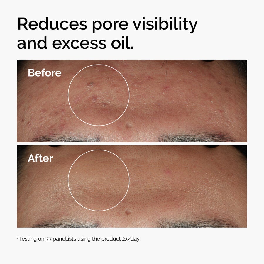 niacinamide-10-zinc-1-t5 ord-niacinamide-zinc-blemish-serum-before-after-pores.jpg