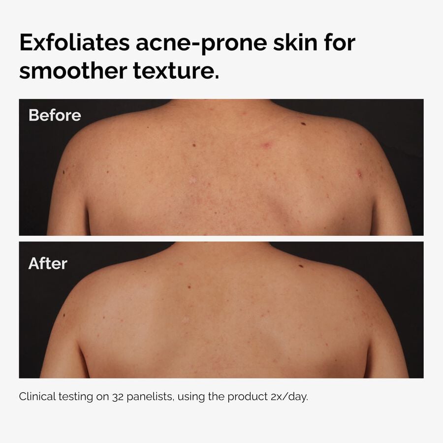 the-body-care-collection-i2 ord-salicylic-acid-body-serum-before-after-graphic-NA.jpg