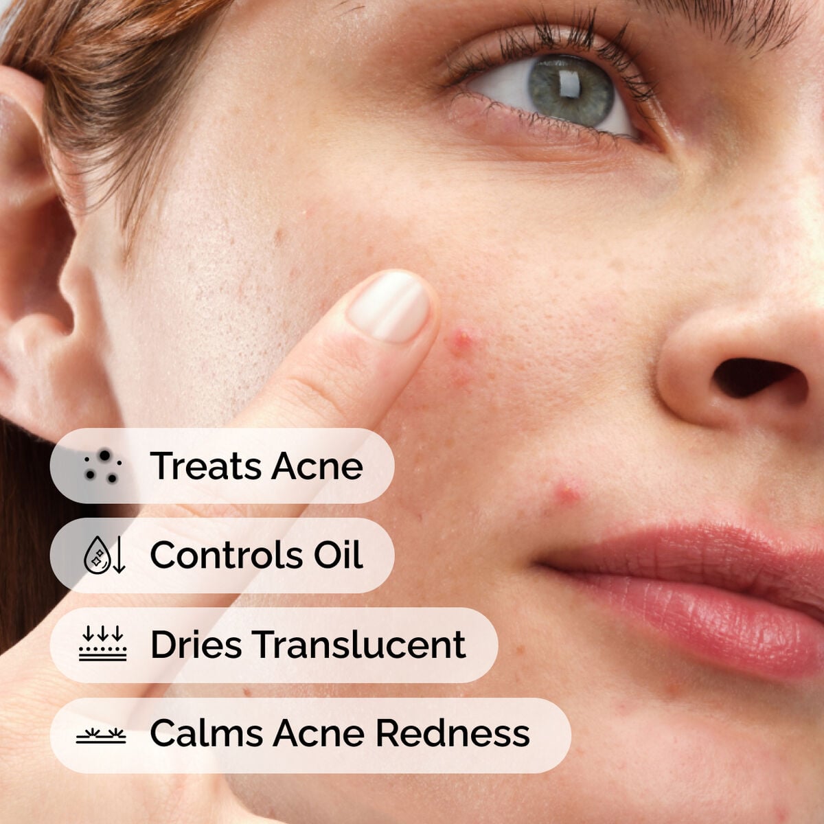 sulfur-10-powder-to-cream-concentrate-s6 ord-sulfur-10pct-powder-to-cream-concentrate-model-application-with-benefits-acne.jpg